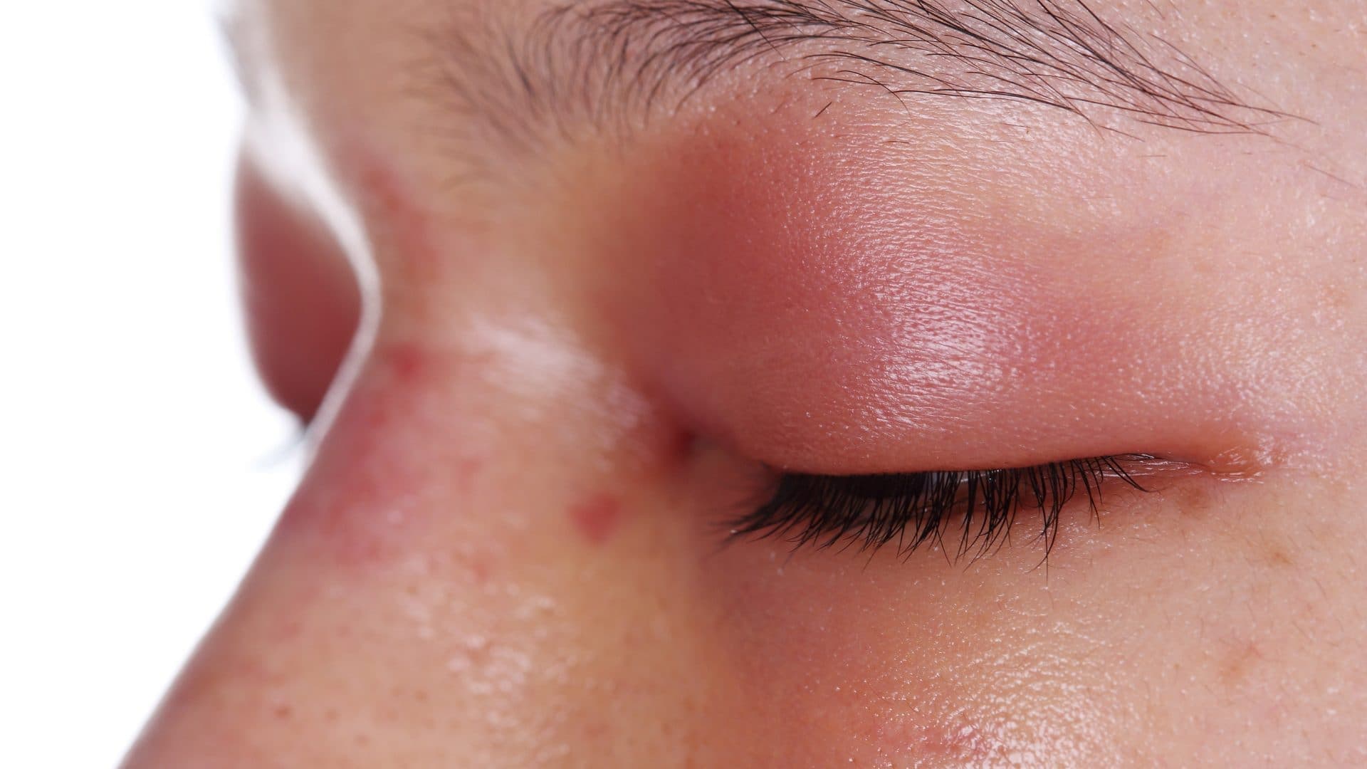 What is the Fastest Way to Heal a Swollen Eyelid? - A Detailed Guide