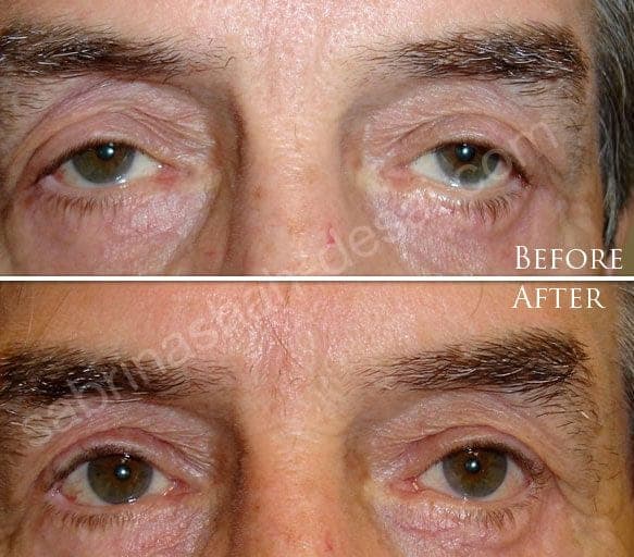 Blepharoplasty before and after - case 13