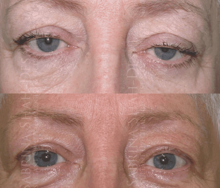 Blepharoplasty before and after - case 14