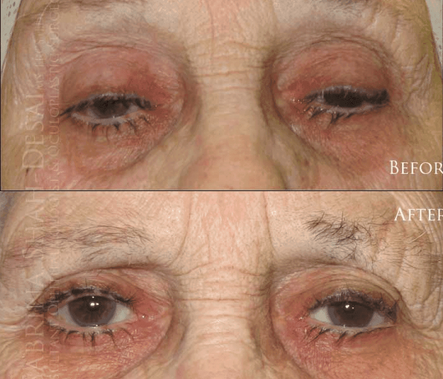 Blepharoplasty before and after - case 16