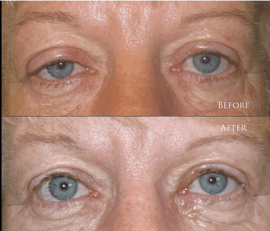 Blepharoplasty before and after - case 17