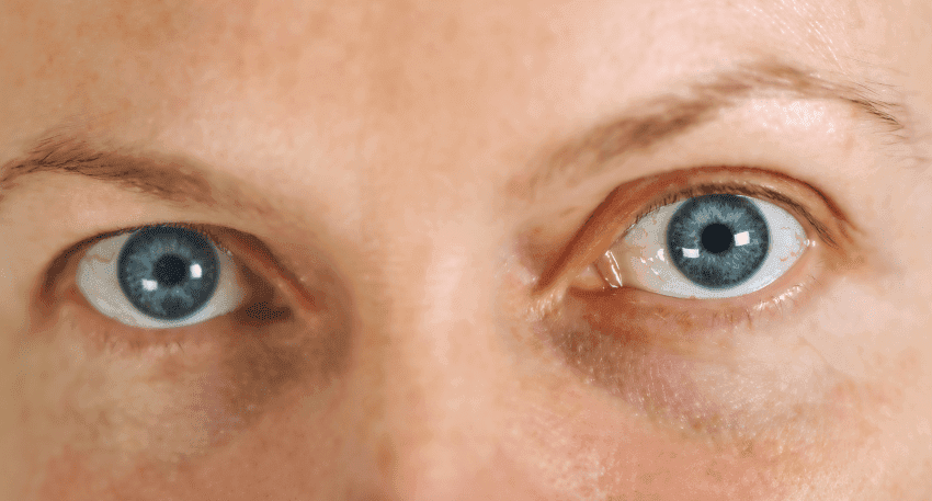 Thyroid Eye Disease (Graves' Disease), explained