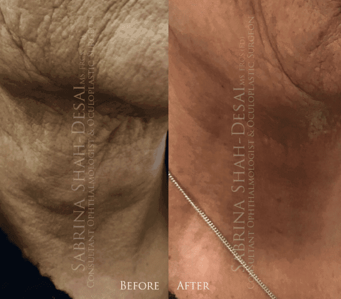 Plexr/Plasma Pen before and after - case 2