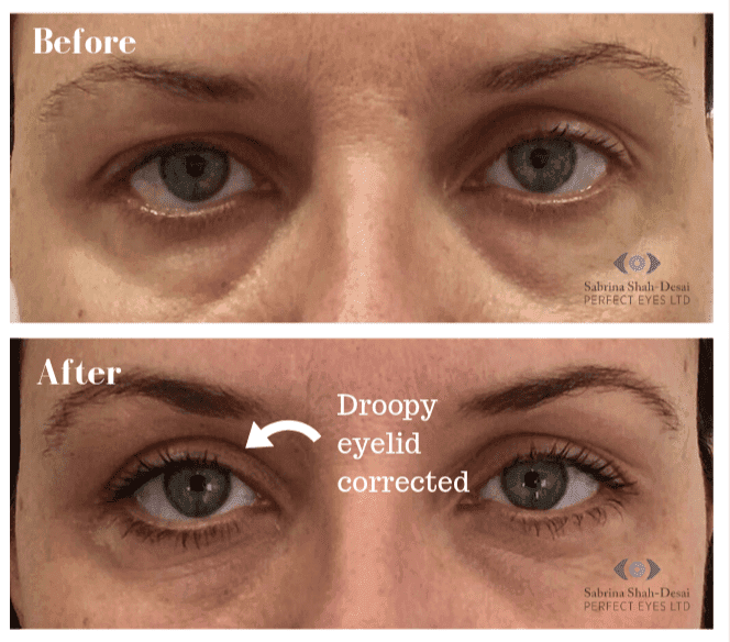 Plexr/Plasma Pen before and after, a patient of Dr Sabrina Shah-Desai