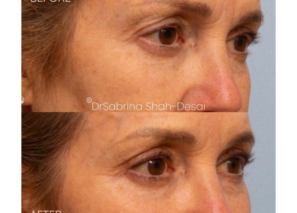 UltraClear Laser before and after - case 3
