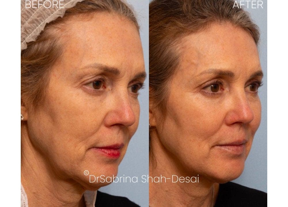UltraClear Laser before and after - case 4
