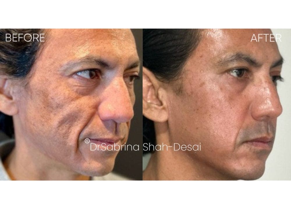 UltraClear Laser before and after - case 7