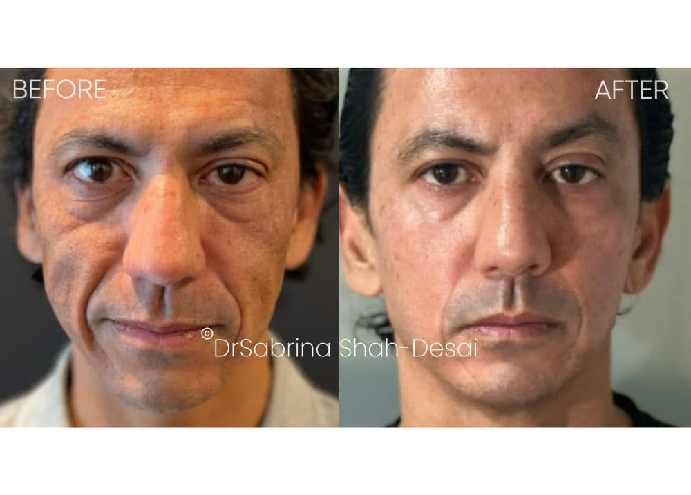 UltraClear Laser before and after - case 8
