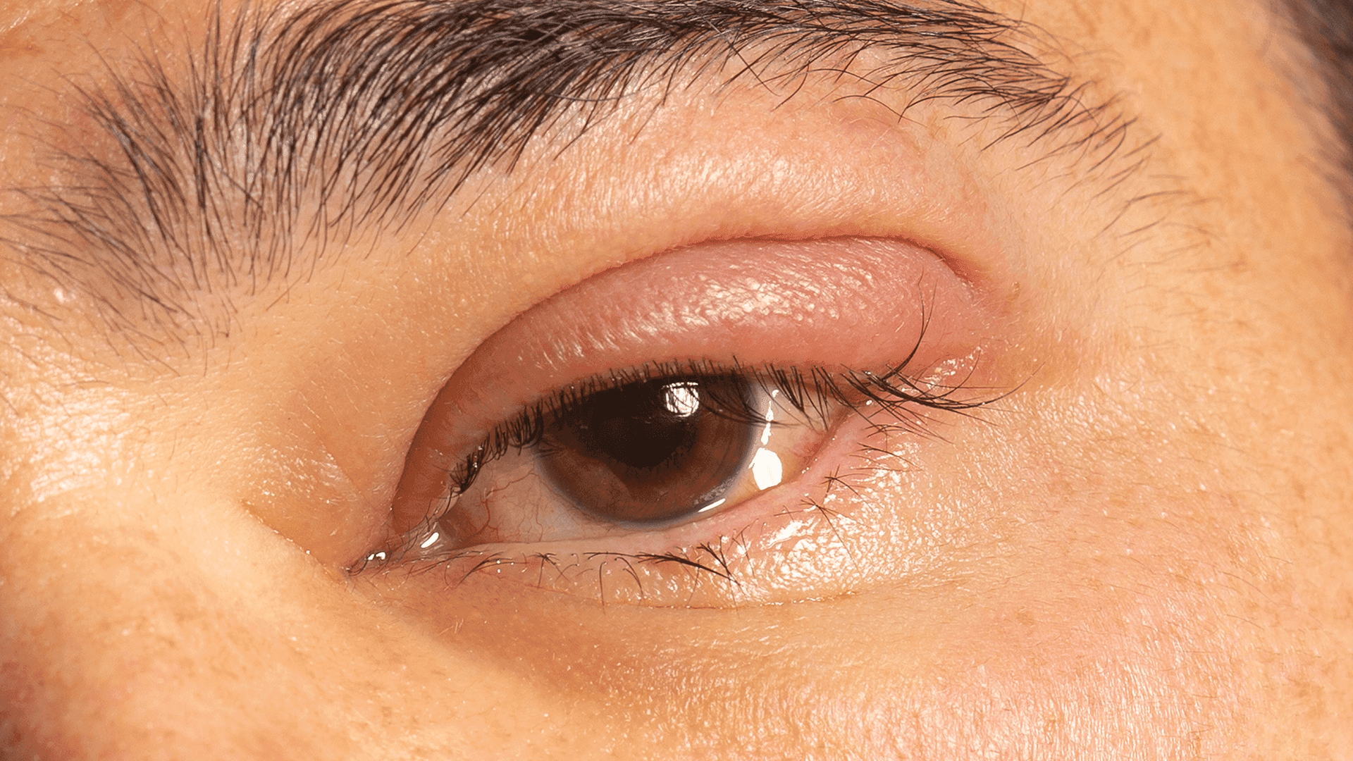 Eyelid Lumps and Bumps Removal