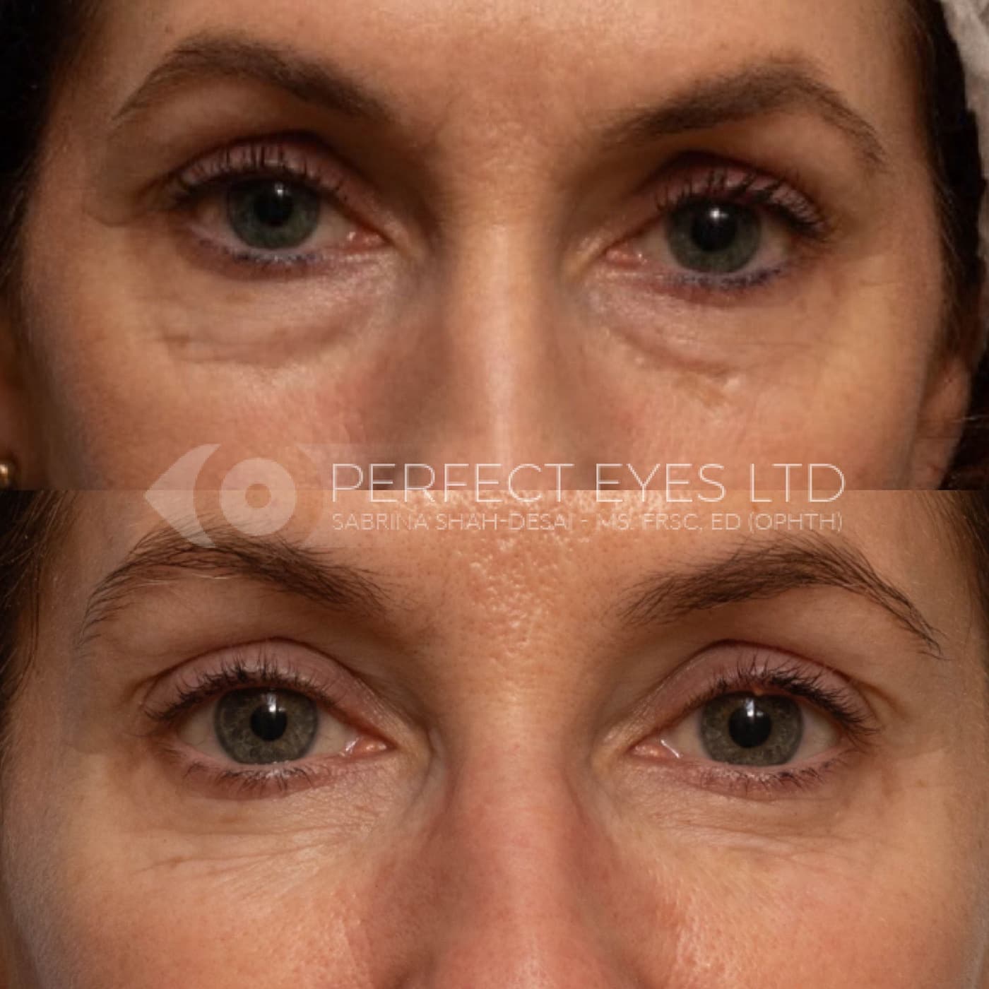 Non-Surgical Eyelid Blepharoplasty before and after, a patient of Dr Sabrina Shah-Desai