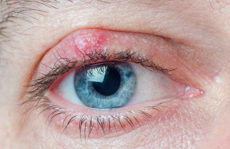 Early Stage of Eyelid Cancer: Symptoms, Causes, & More