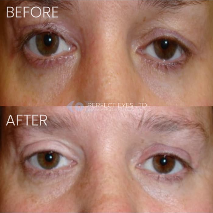 Revision Blepharoplasty before and after - case 1