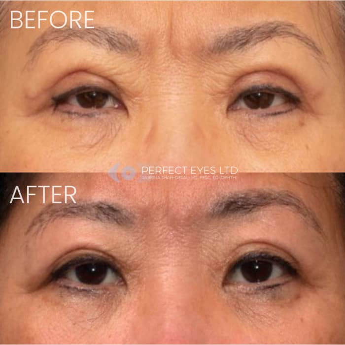 Revision Blepharoplasty before and after - case 2