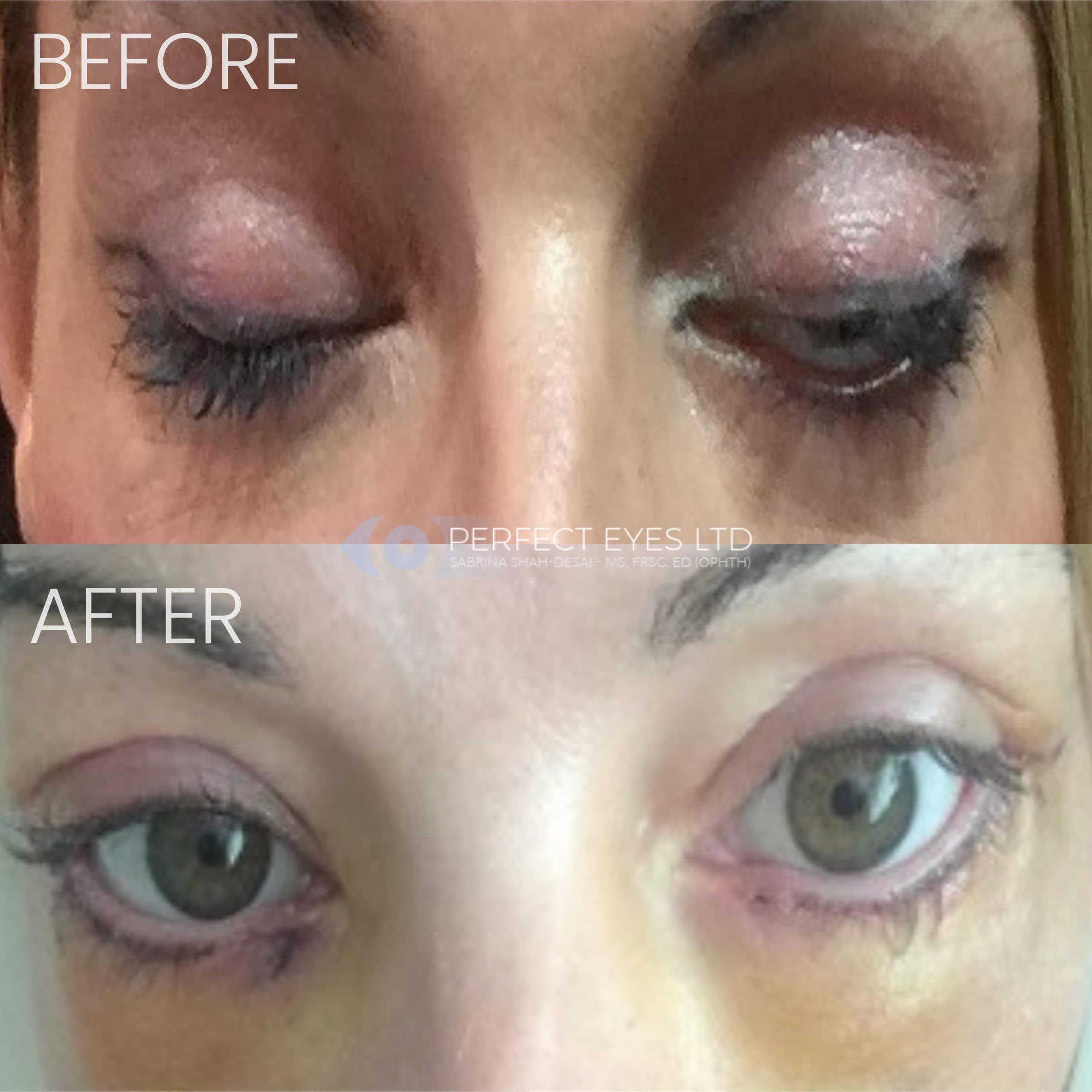 Revision Blepharoplasty before and after - case 4
