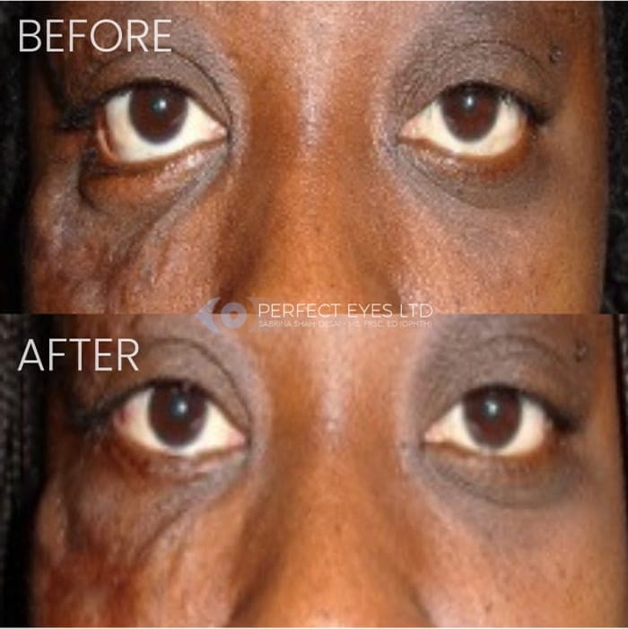 Revision Blepharoplasty before and after - case 5