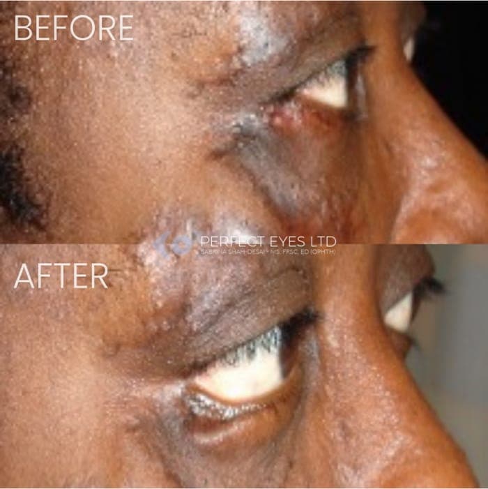 Revision Blepharoplasty before and after - case 6