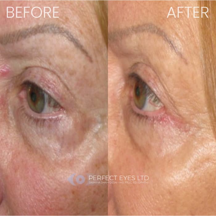 Revision Blepharoplasty before and after - case 7