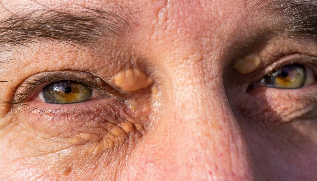 Cholesterol Bumps Under Eyes: Causes, Treatments, and More