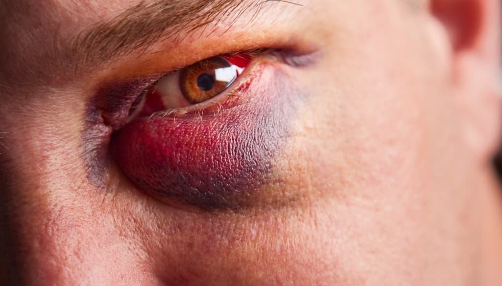 How Long Does a Black Eye Last: Causes and Treatment