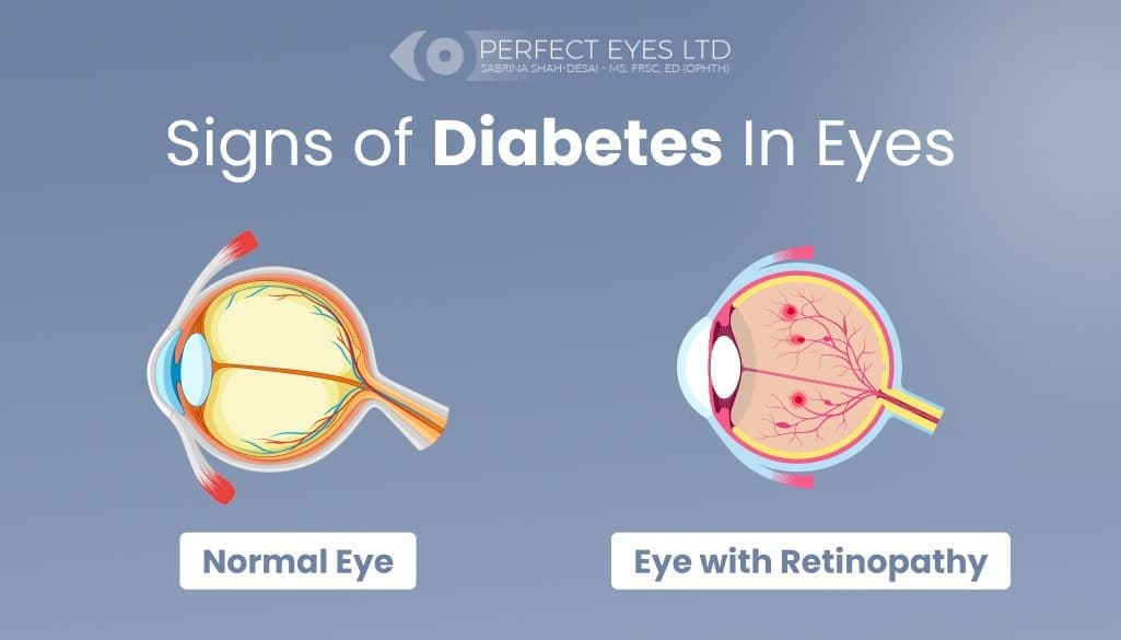 Early Stage Diabetes Eyes Symptoms: What To Look For?