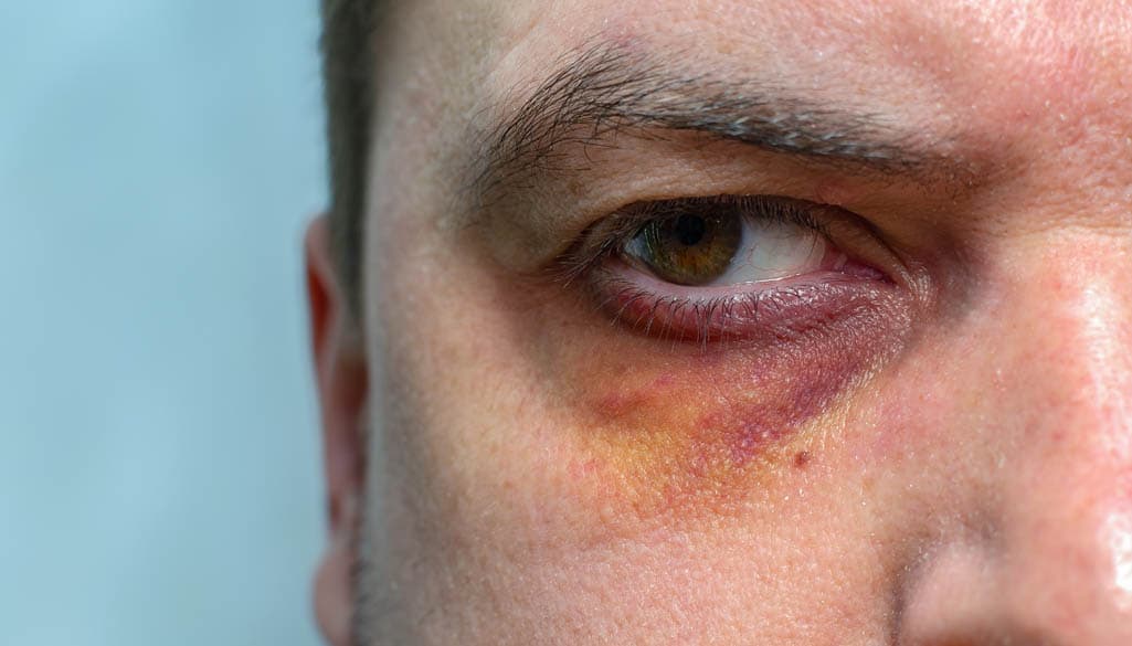 Sunburned Eyes: Best Way to Treat