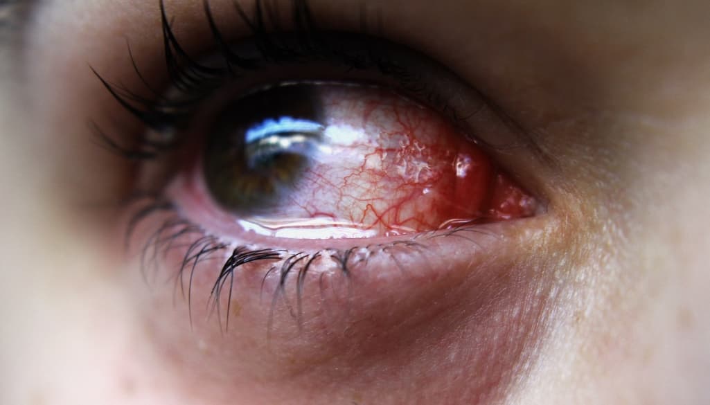 Why Are My Bloodshot Eyes?