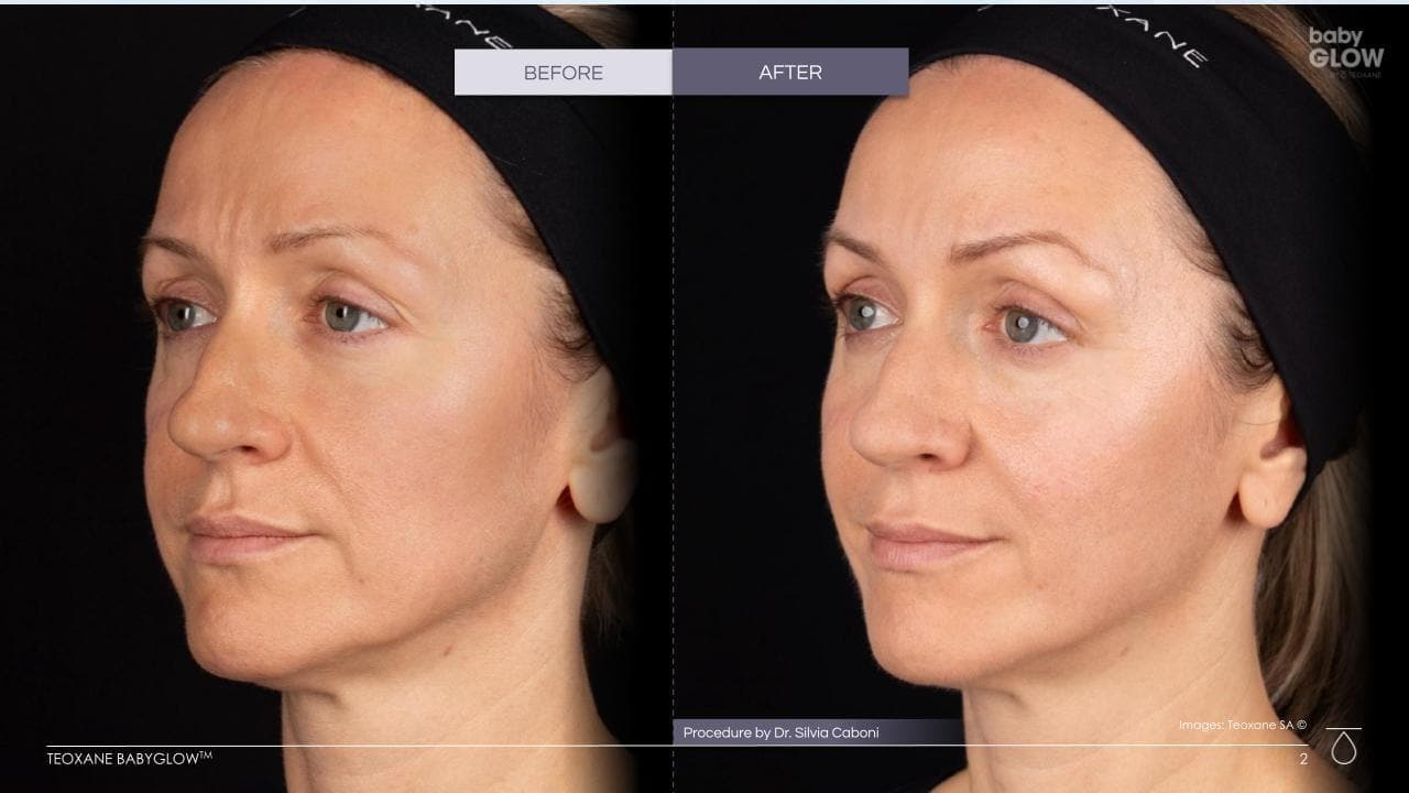 Teoxane babyGLOW Skin before and after - case 2