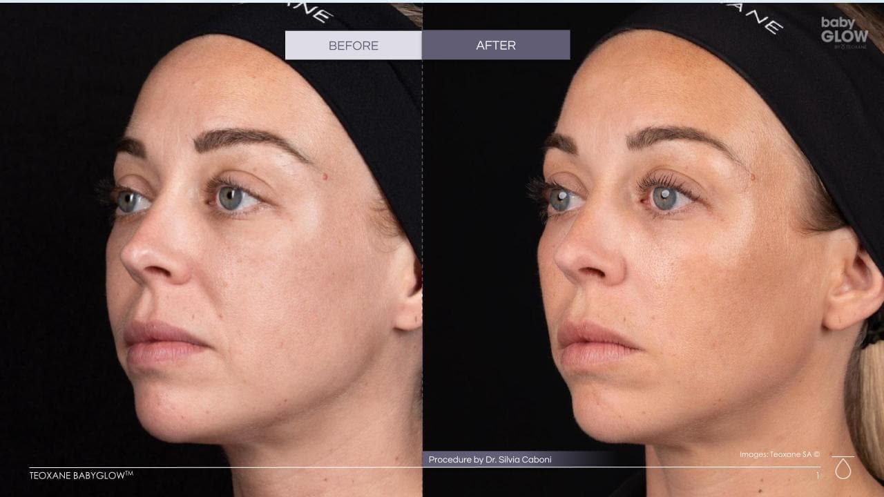 Teoxane Redensity 1 before and after, a patient of Dr Sabrina Shah-Desai