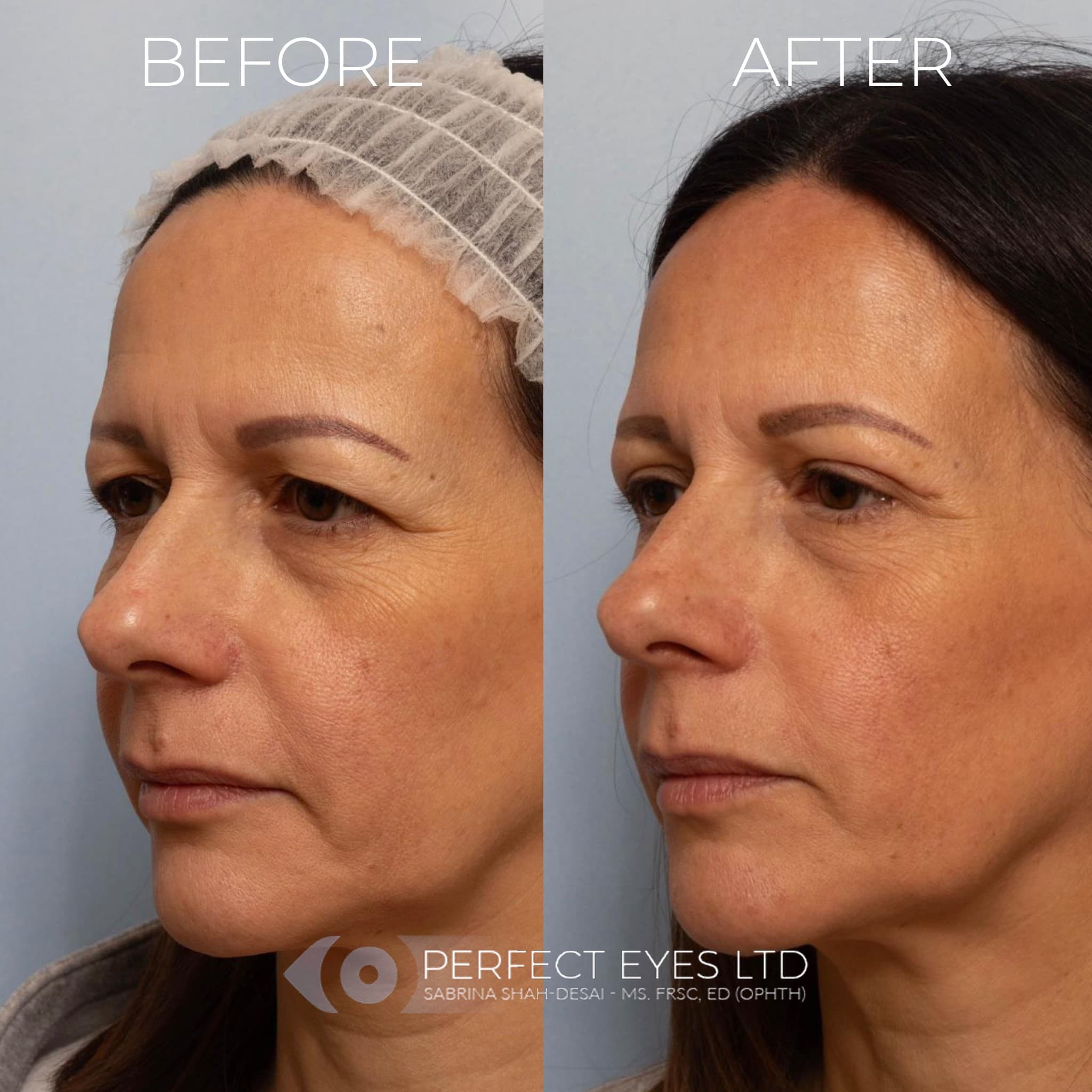 Sofwave™ before and after - case 2