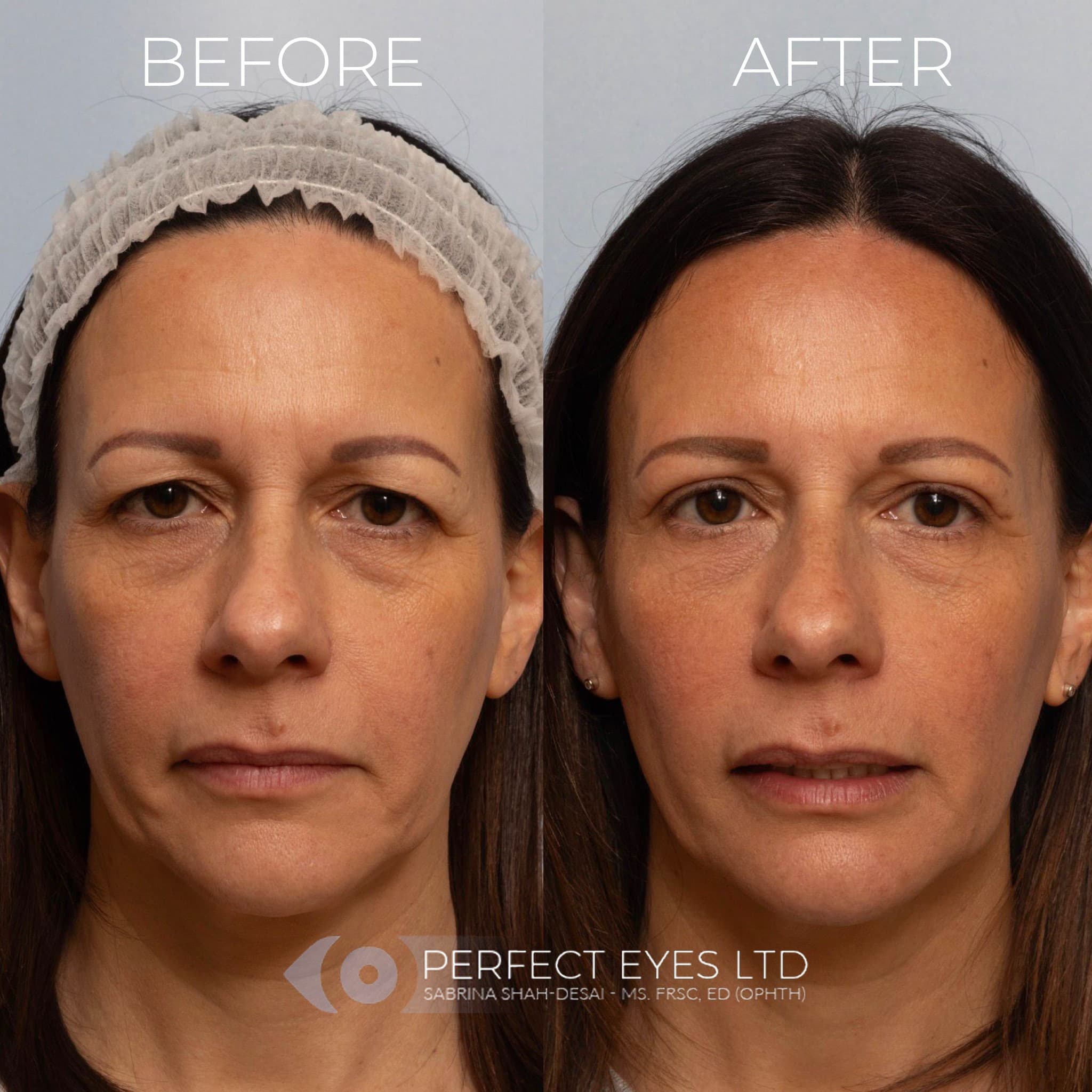 Sofwave™ before and after - case 4
