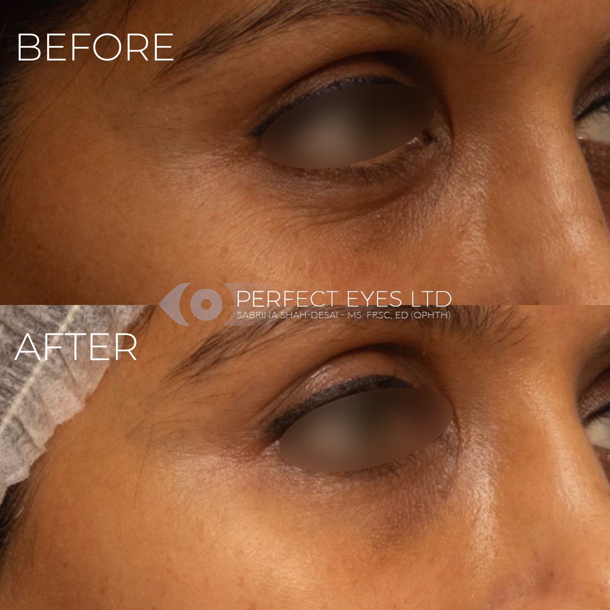 Before and after Polynucleotides, a patient of Dr Sabrina Shah-Desai