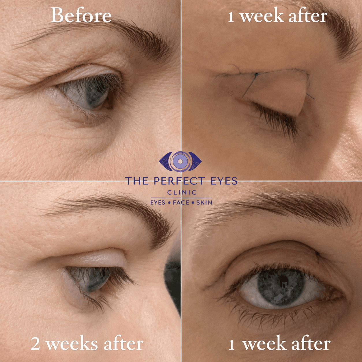 Upper blepharoplasty before and after, case 10, by Dr Sabrina Shah-Desai