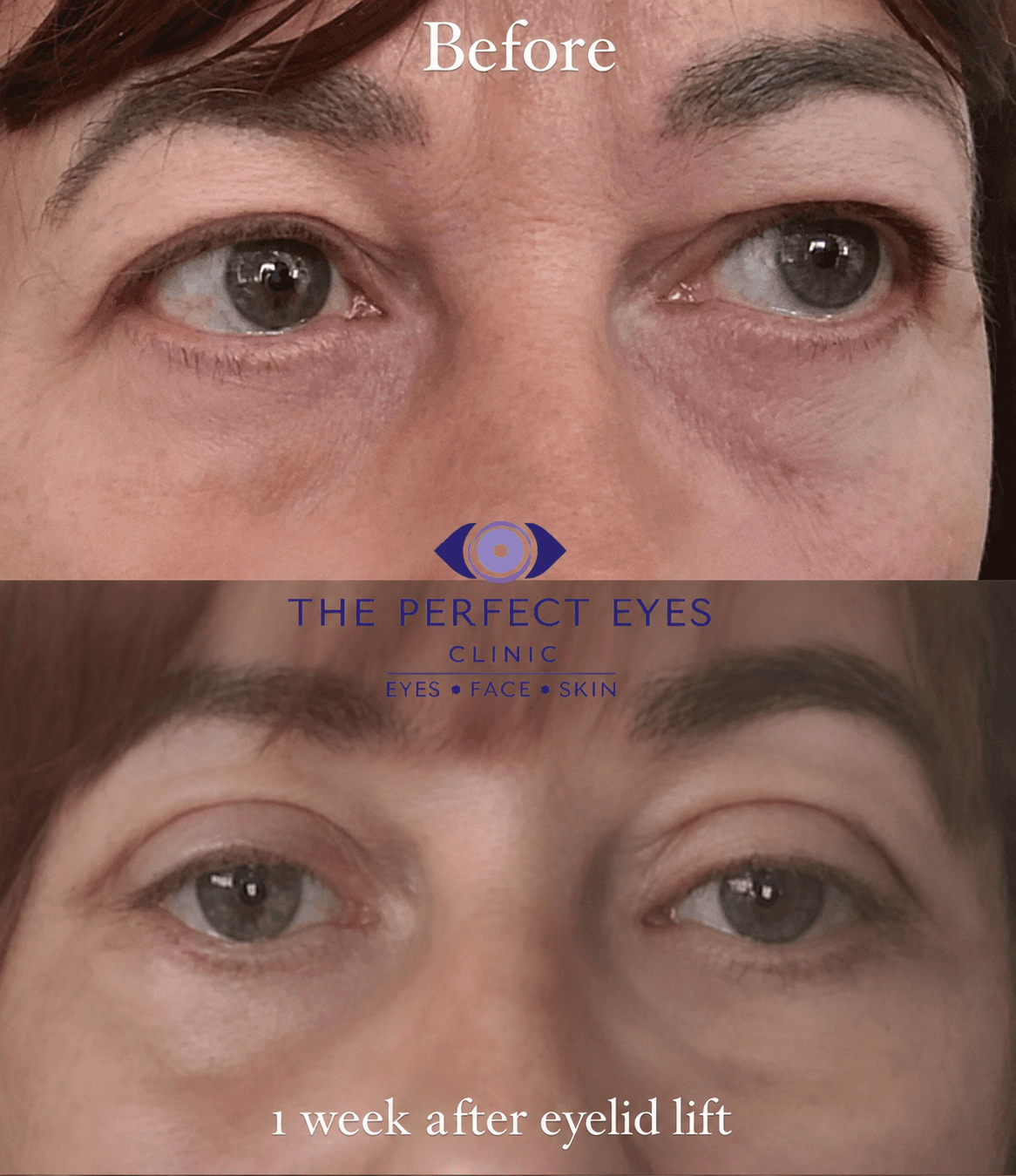 Upper blepharoplasty before and after, case 11, by Dr Sabrina Shah-Desai