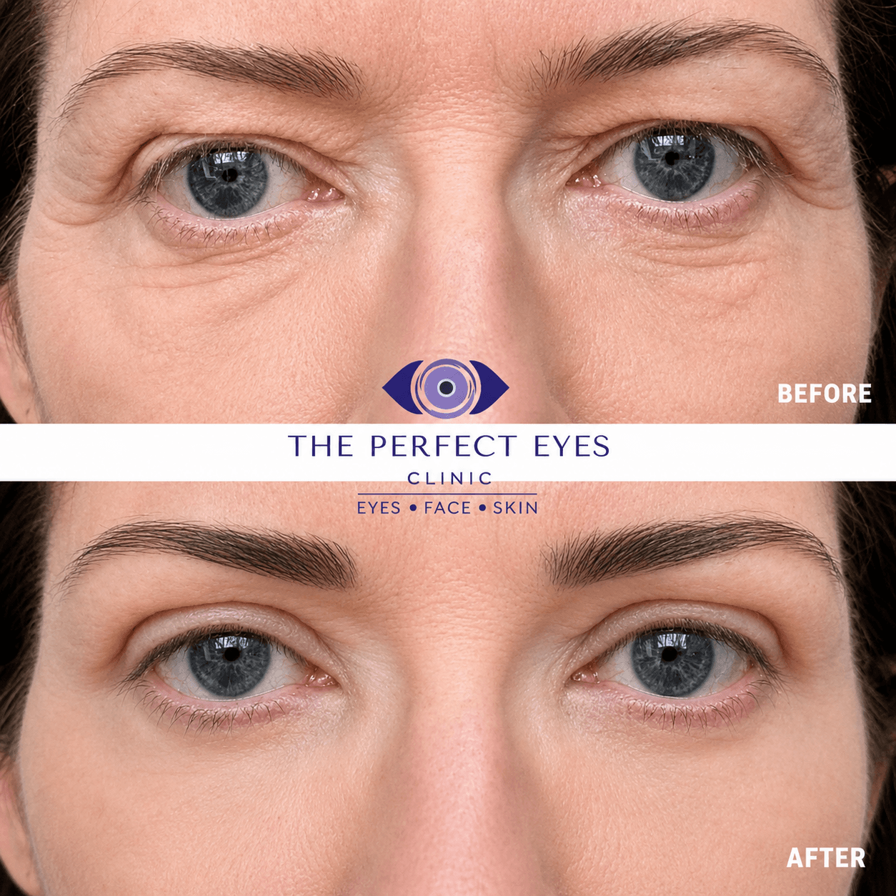 Upper blepharoplasty before and after, case 12, by Dr Sabrina Shah-Desai