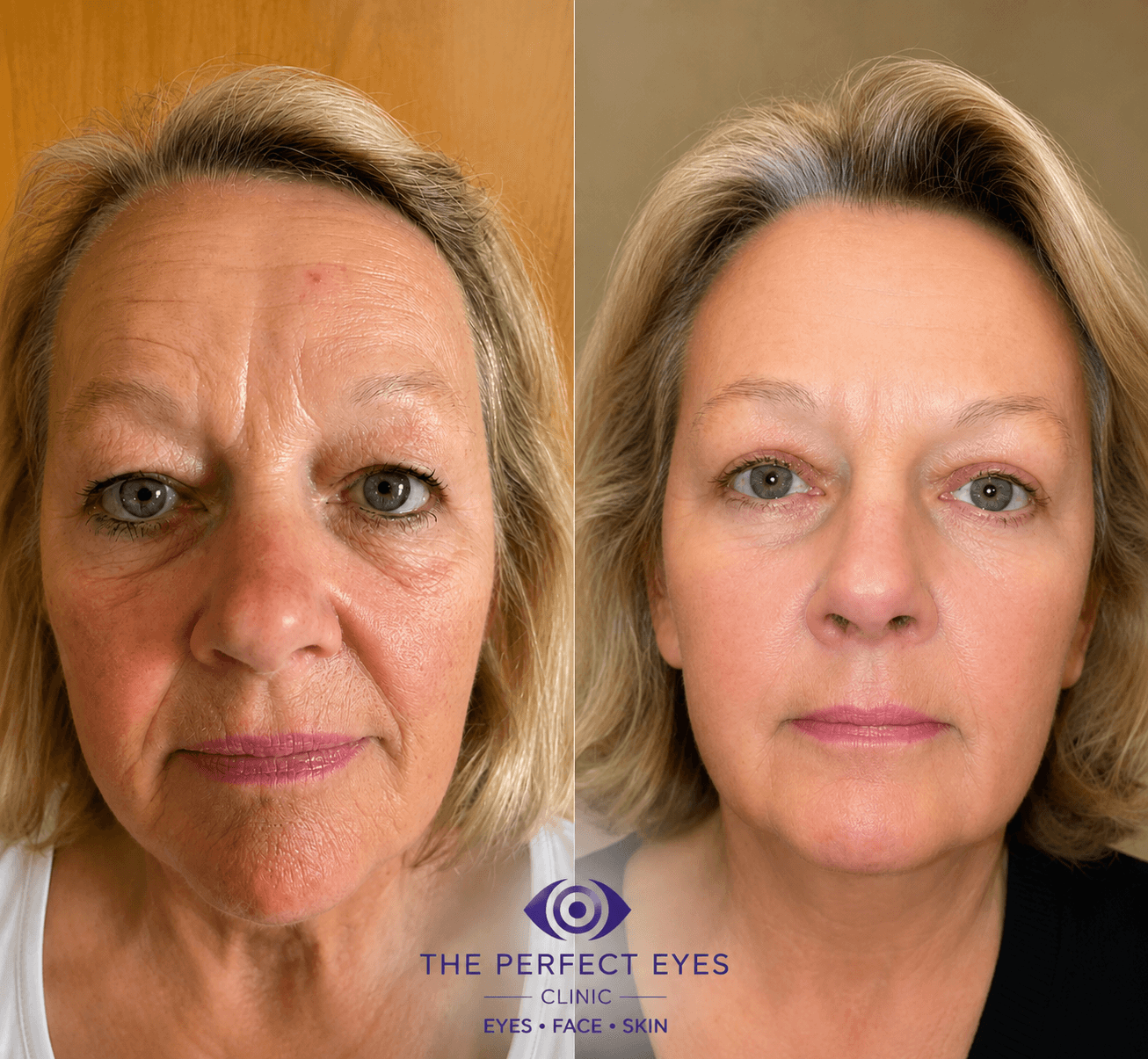 Upper blepharoplasty before and after, case 2, by Dr Sabrina Shah-Desai