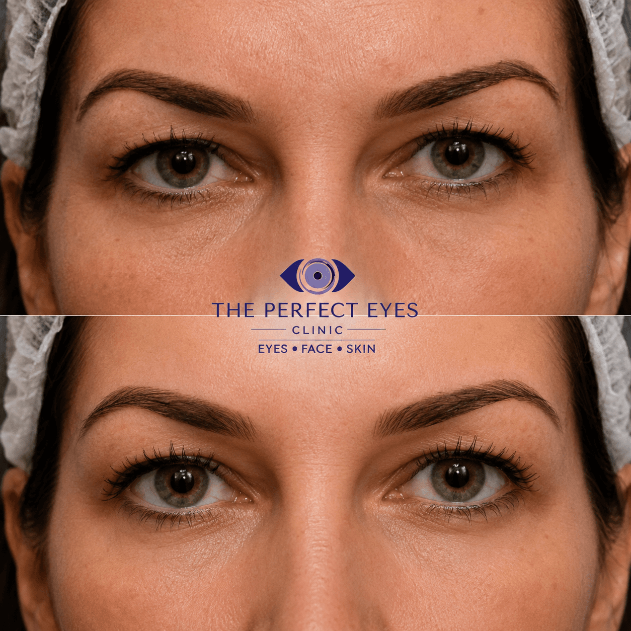 Upper blepharoplasty before and after, case 3, by Dr Sabrina Shah-Desai