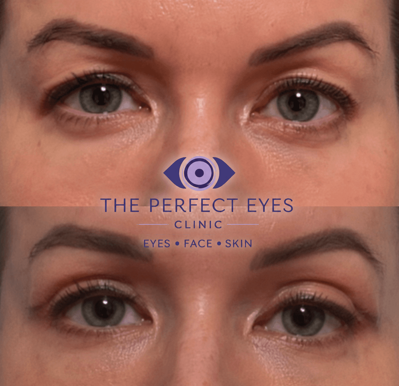 Upper blepharoplasty before and after, case 4, by Dr Sabrina Shah-Desai