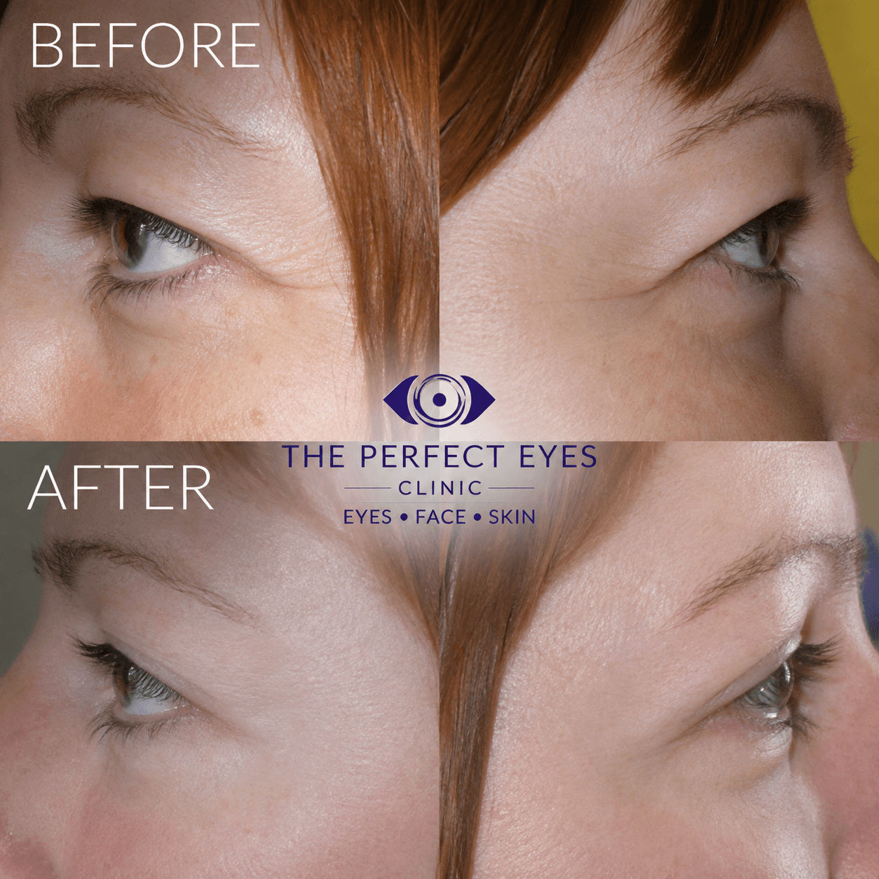 Upper blepharoplasty before and after, case 5, by Dr Sabrina Shah-Desai