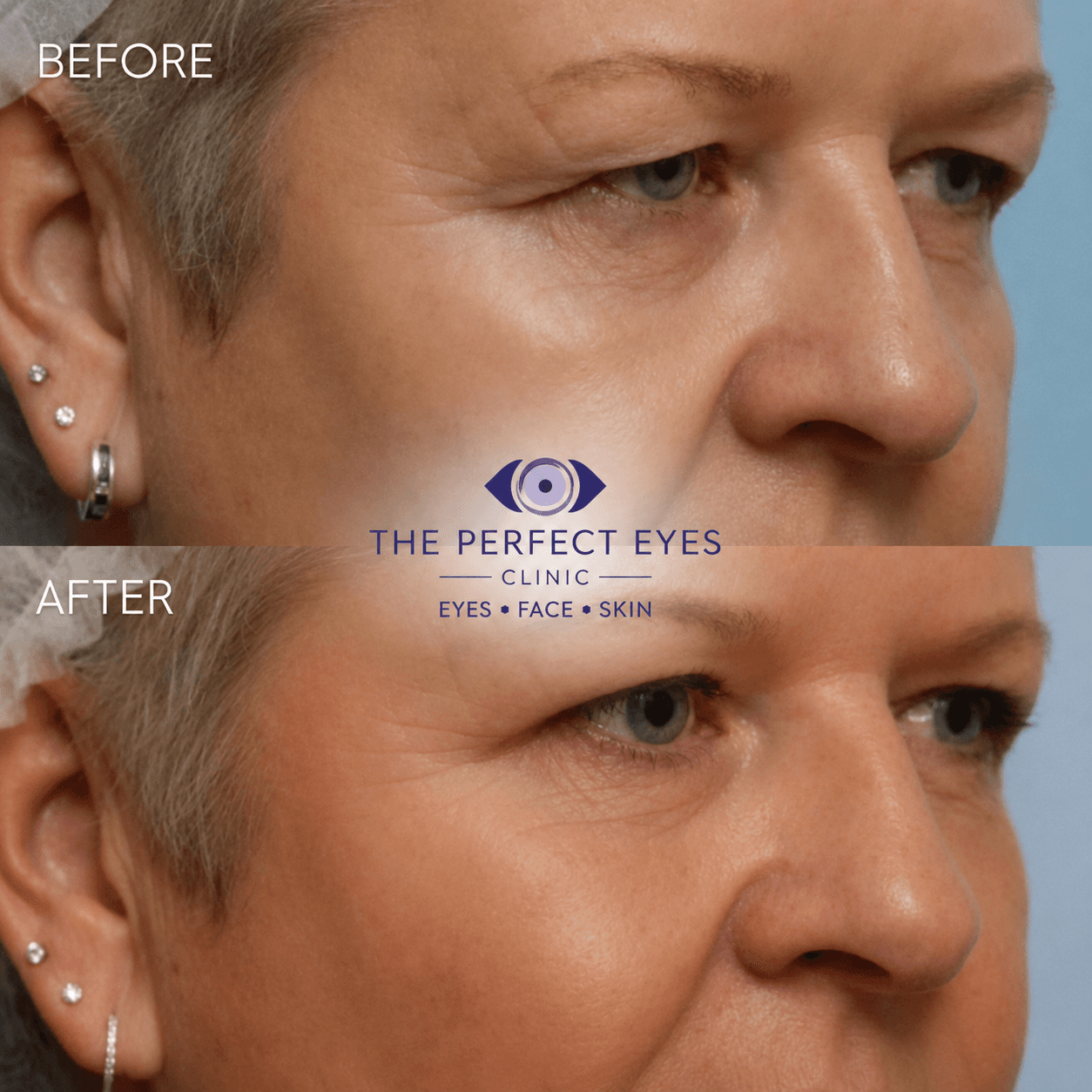 Upper blepharoplasty before and after, case 6, by Dr Sabrina Shah-Desai