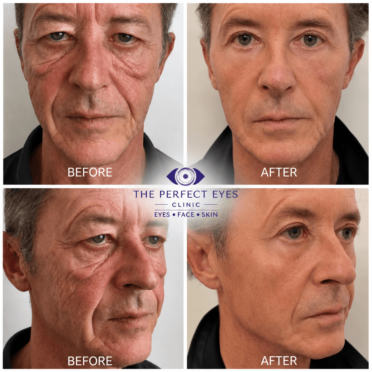 Upper blepharoplasty before and after, case 8, by Dr Sabrina Shah-Desai
