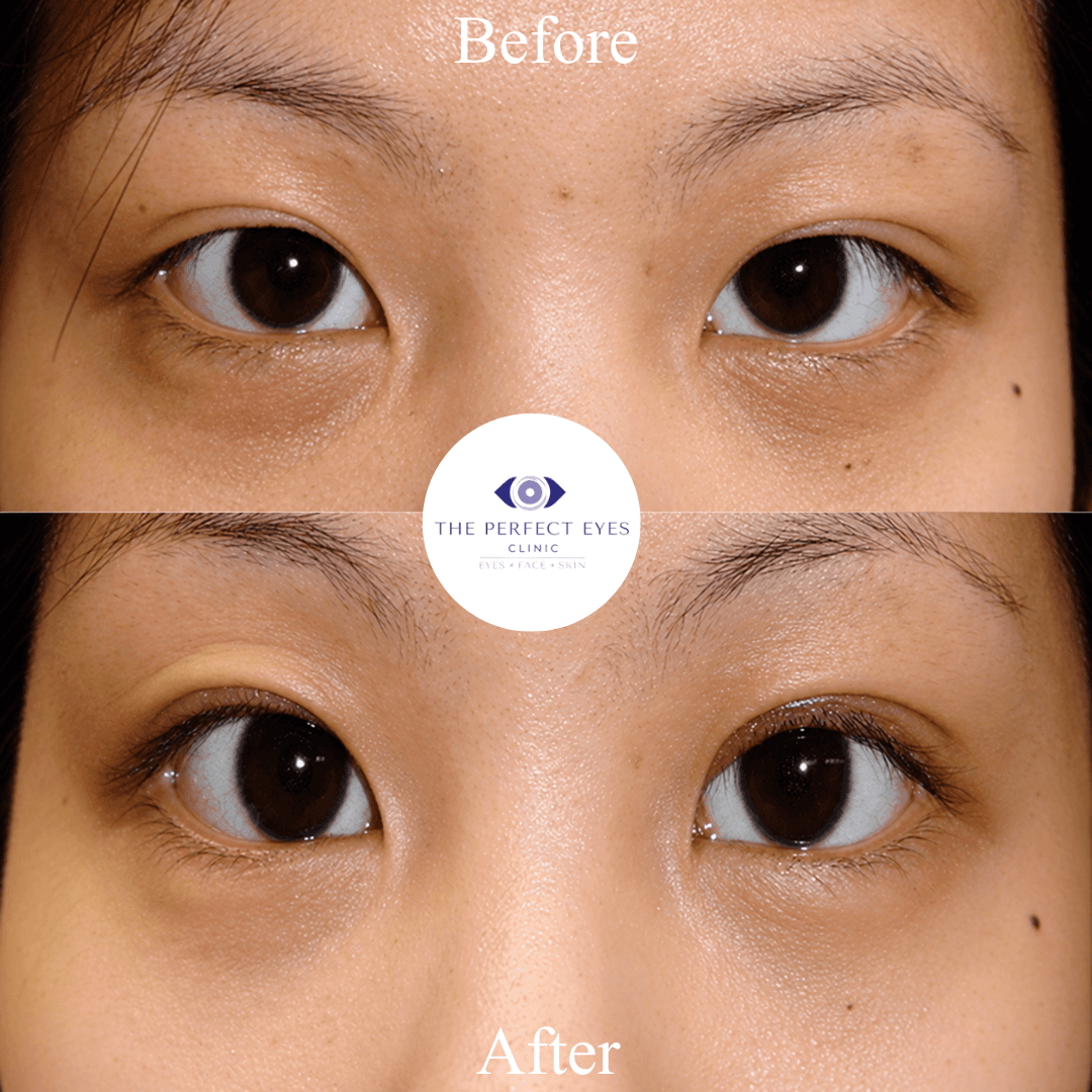 Asian blepharoplasty before and after, case 1, by Dr Sabrina Shah-Desai