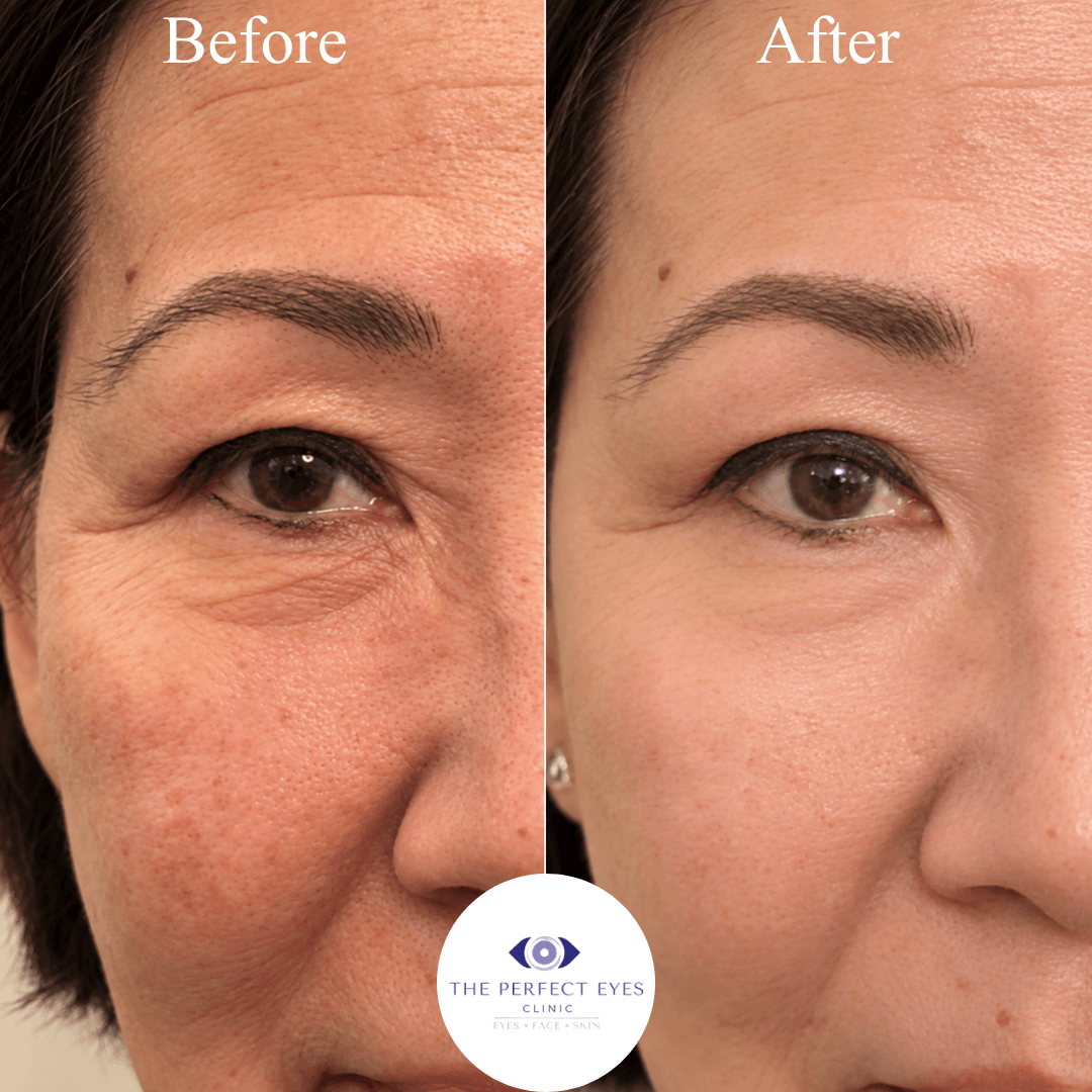 Asian blepharoplasty before and after, case 2, by Dr Sabrina Shah-Desai