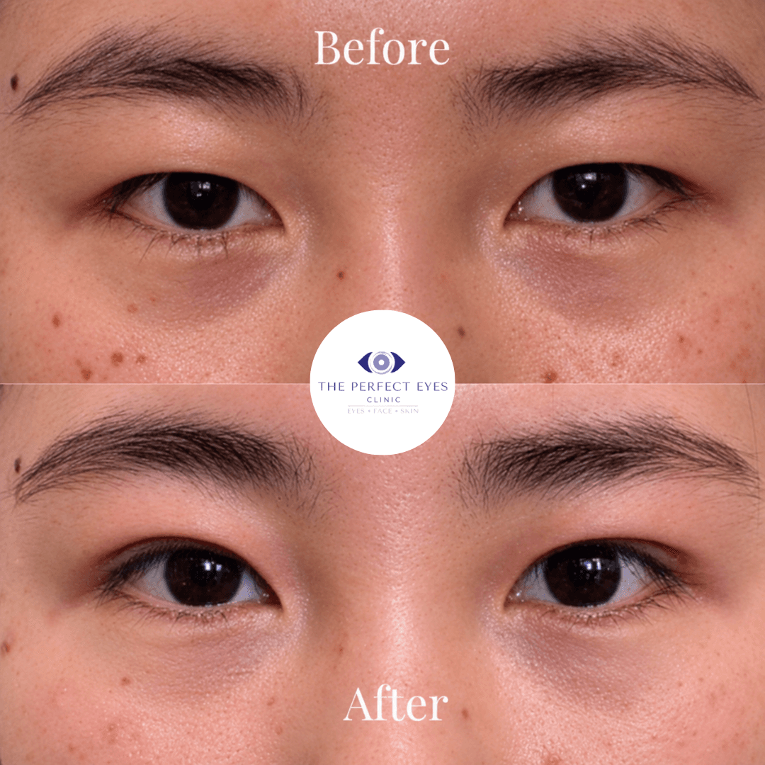 Asian blepharoplasty before and after, case 3, by Dr Sabrina Shah-Desai
