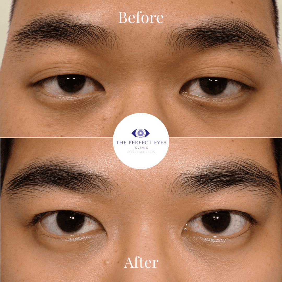 Asian blepharoplasty before and after, case 4, by Dr Sabrina Shah-Desai