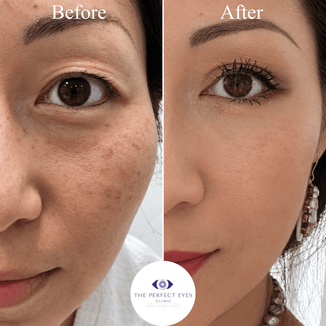 Asian blepharoplasty before and after, case 5, by Dr Sabrina Shah-Desai