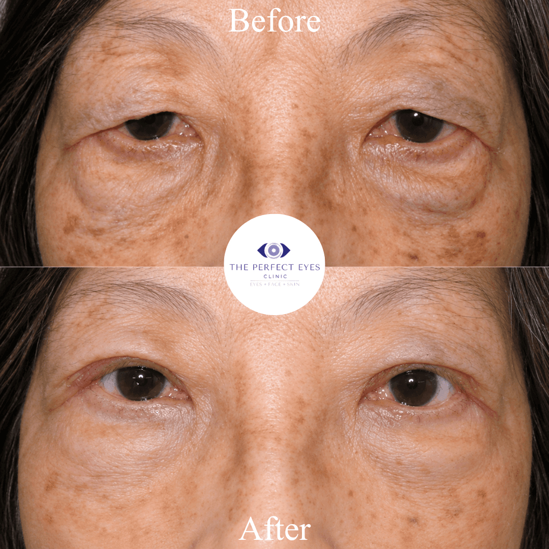 Asian blepharoplasty before and after, case 6, by Dr Sabrina Shah-Desai
