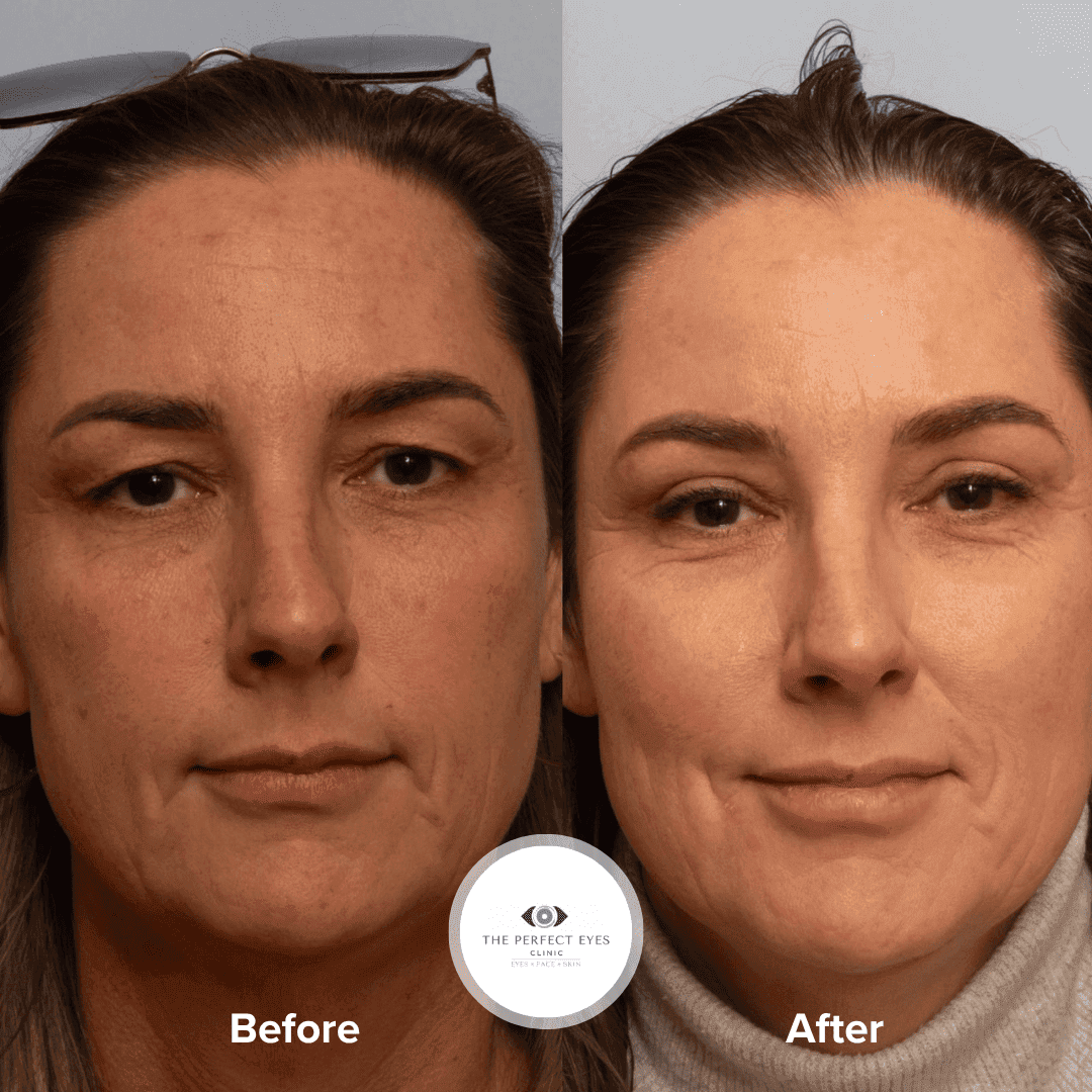 Upper Blepharoplasty before and after, a patient of Dr Sabrina Shah-Desai