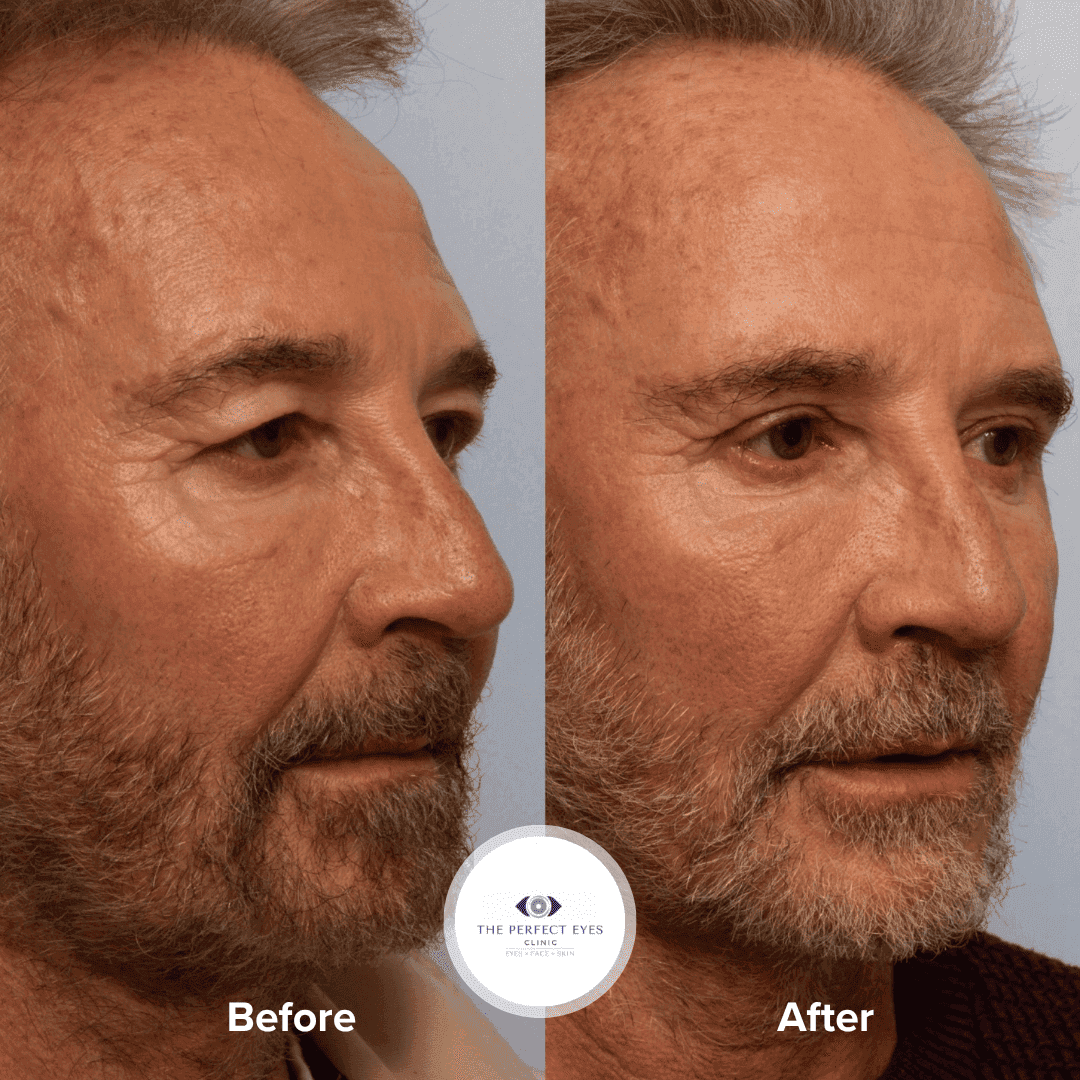Ptosis Surgery before and after, a patient of Dr Sabrina Shah-Desai
