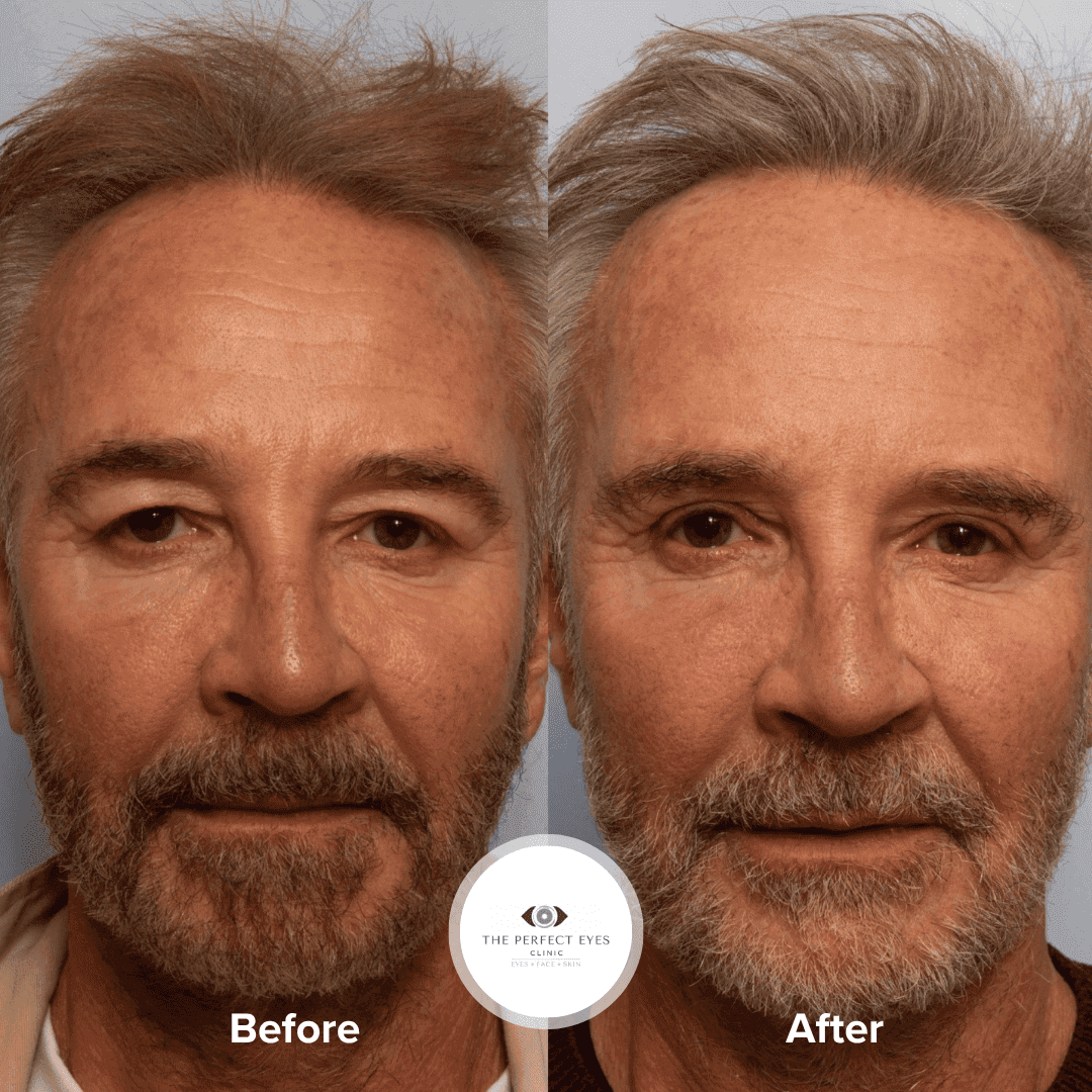Upper Eyelid Blepharoplasty & Ptosis Surgery before and after, a patient of Dr Sabrina Shah-Desai