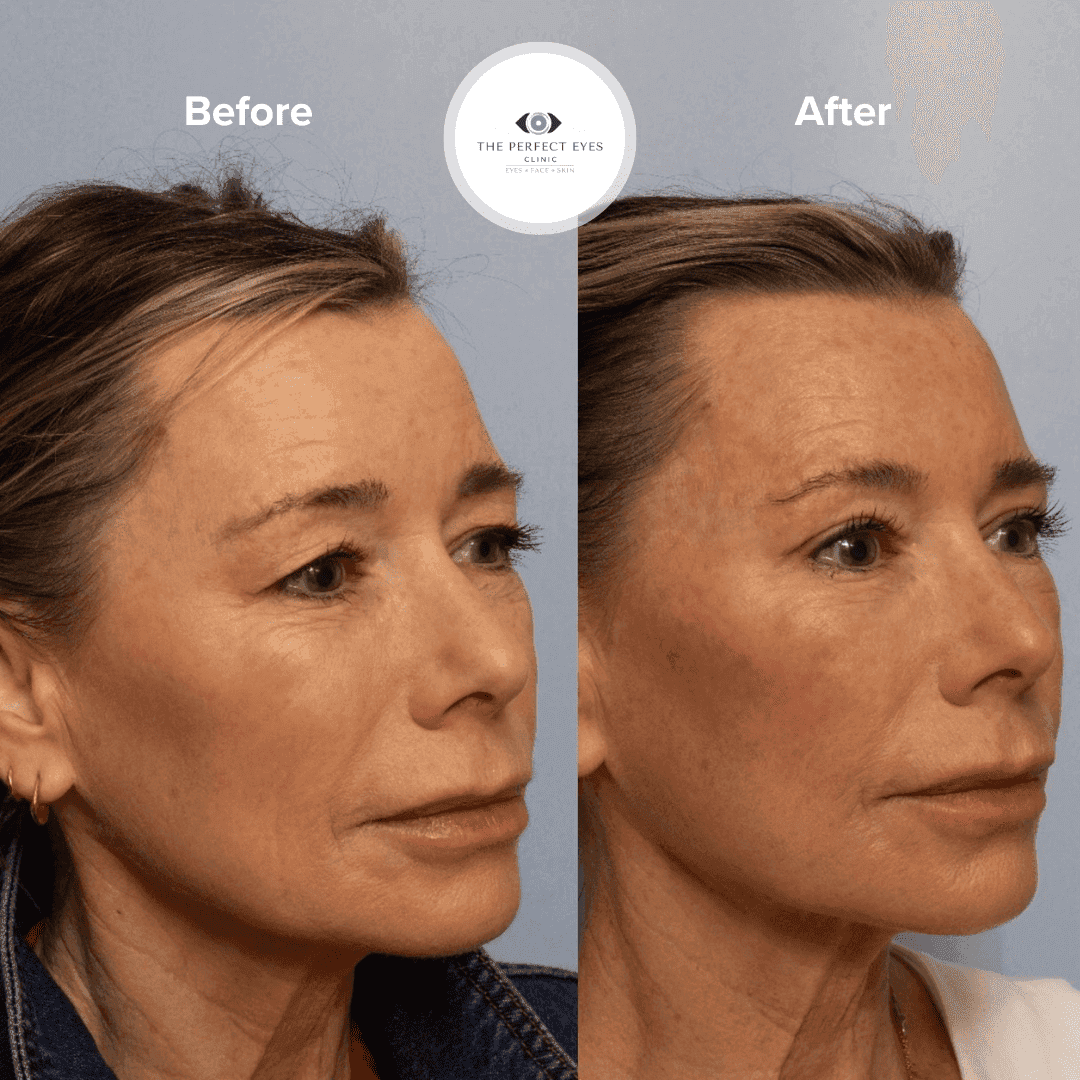 Upper Blepharoplasty before and after, a patient of Dr Sabrina Shah-Desai